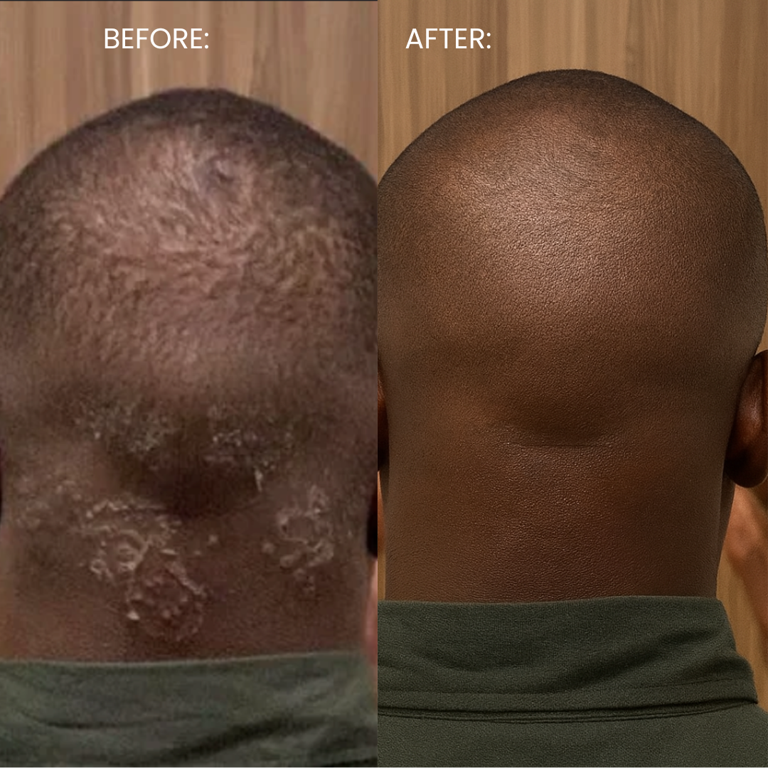 Smooth. Brighten. Bump-Free. Ingrown Hair & Razor Bump Solution — In Just 3 Days.