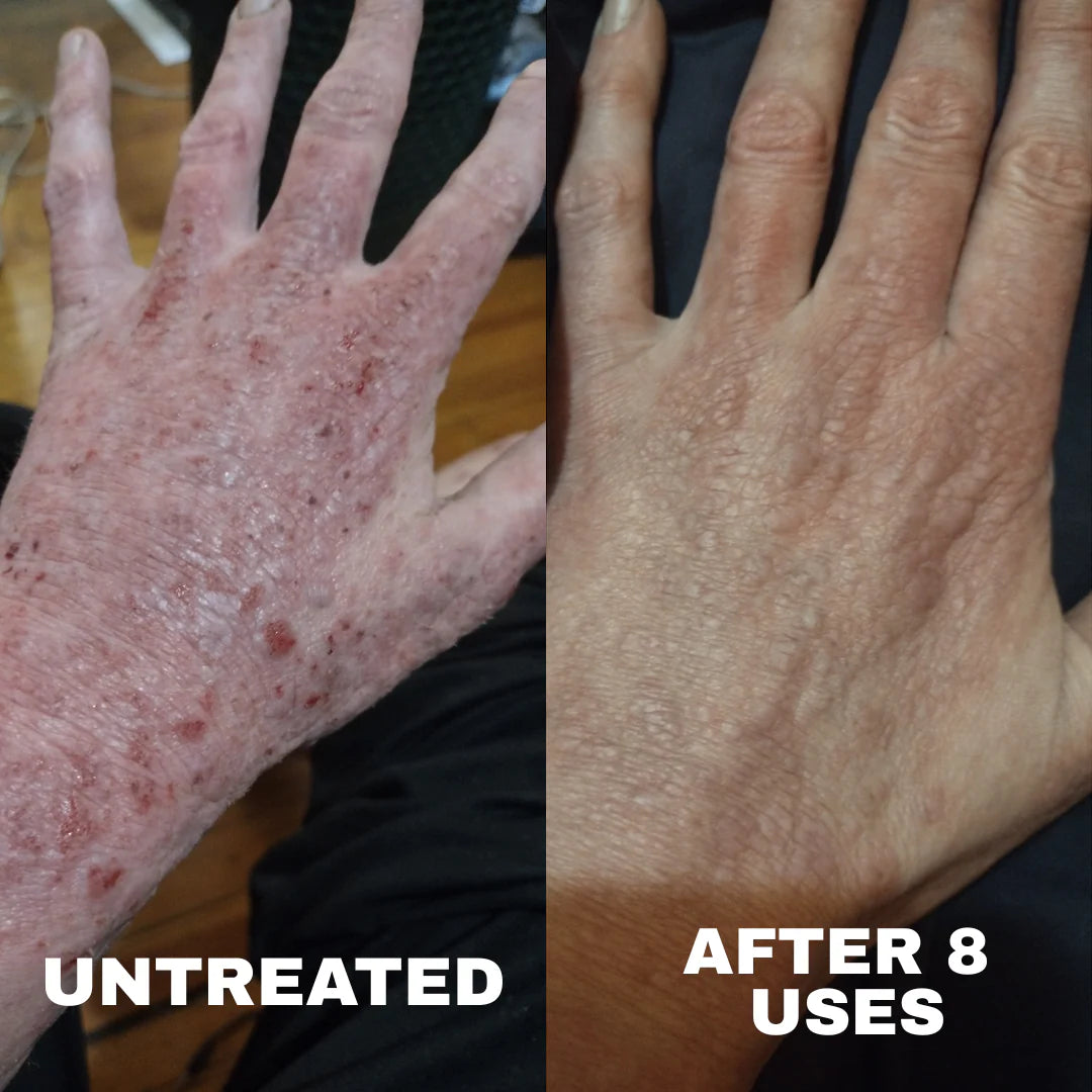 MD Formulated Barrier Repair Complex for Eczema