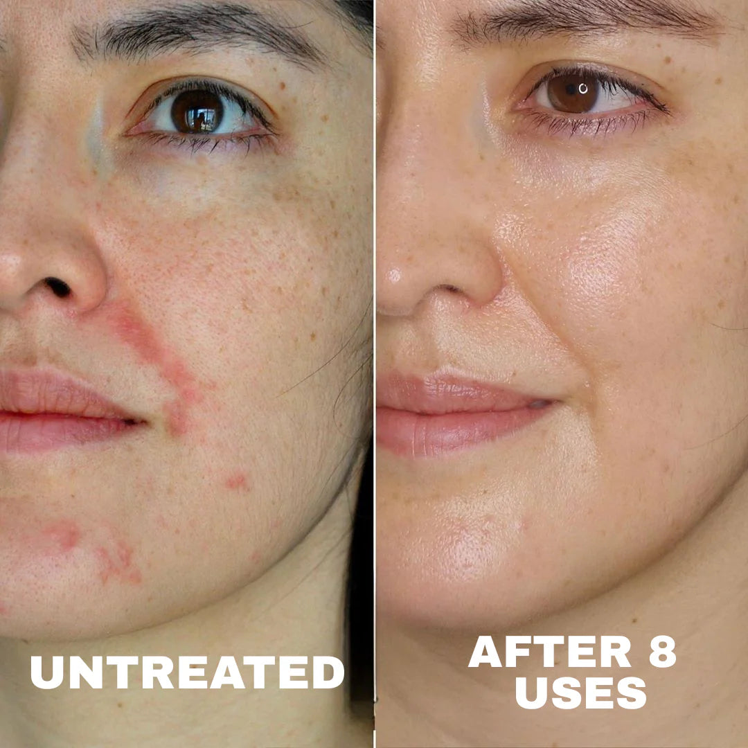 MD Formulated Barrier Repair Complex for Eczema