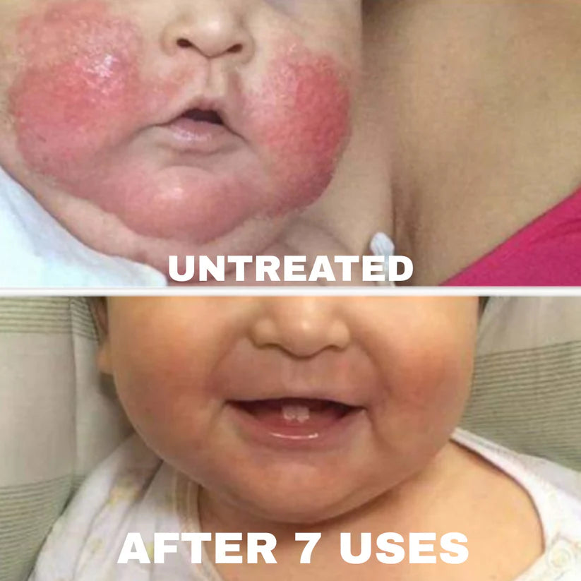 MD Formulated Barrier Repair Complex for Eczema