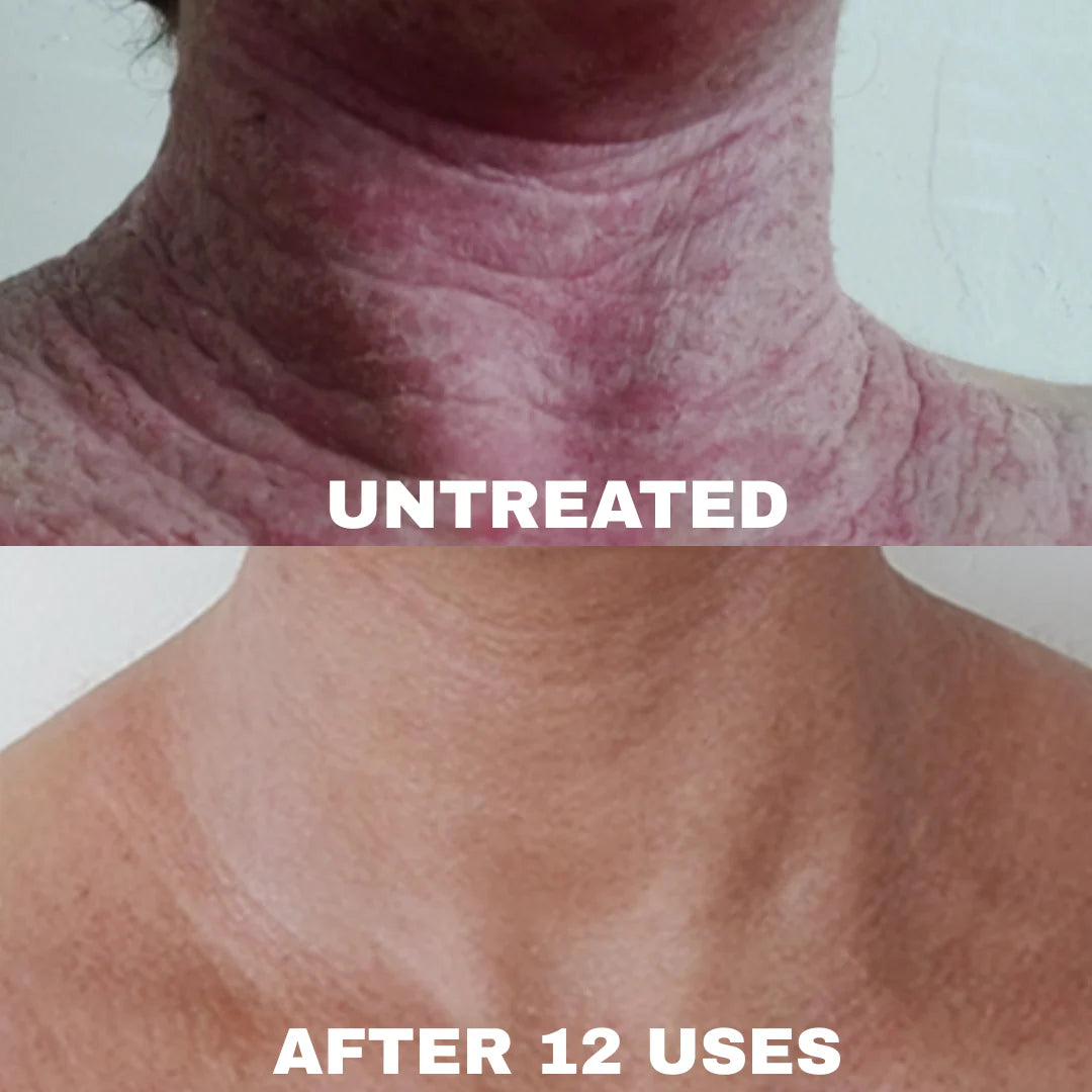 MD Formulated Barrier Repair Complex for Eczema