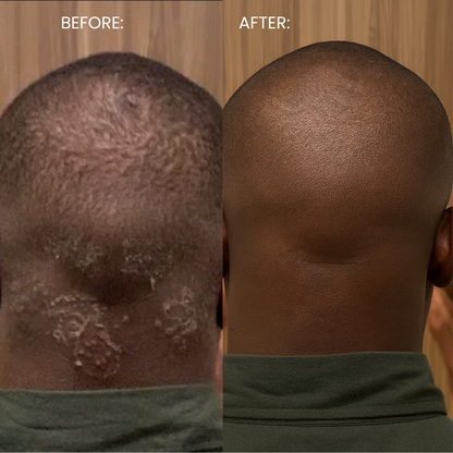 Smooth. Brighten. Bump-Free. Ingrown Hair & Razor Bump Solution — In Just 3 Days.