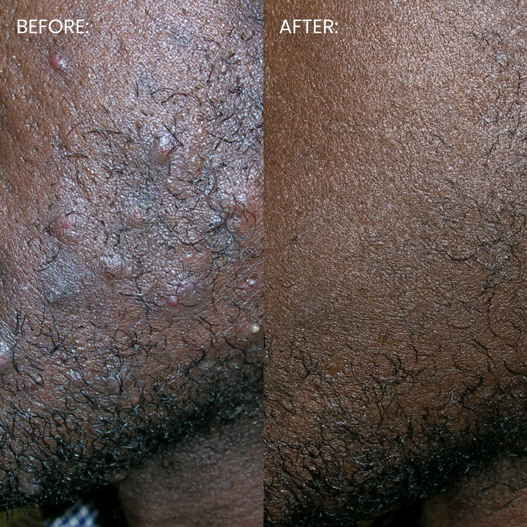 Smooth. Brighten. Bump-Free. Ingrown Hair & Razor Bump Solution — In Just 3 Days.