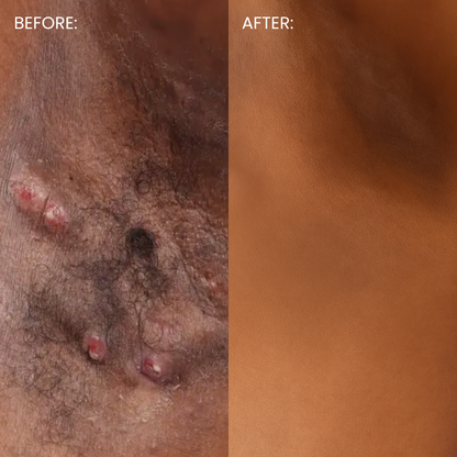 Smooth. Brighten. Bump-Free. Ingrown Hair & Razor Bump Solution — In Just 3 Days.
