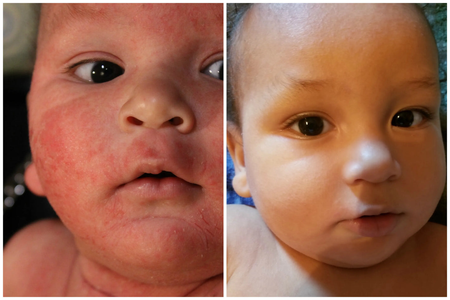 OceanBarrier Cream for Kids. Nonsteroid Solution Created By Harvard MDs.The Ocean Heals. The Barrier Seals