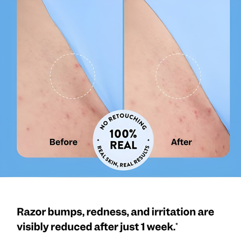 ✨ Smooth. Brighten. Bump-Free. Ingrown Hair & Razor Bump Solution — In Just 3 Days.