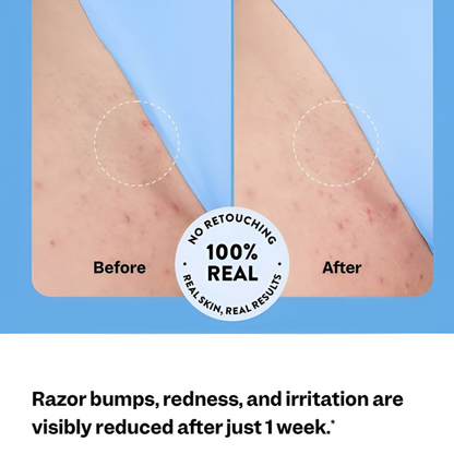✨ Smooth. Brighten. Bump-Free. Ingrown Hair & Razor Bump Solution — In Just 3 Days.